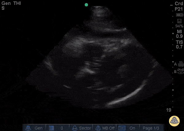 Exudative Effusion