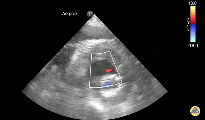 Aortic Graft Endoleak