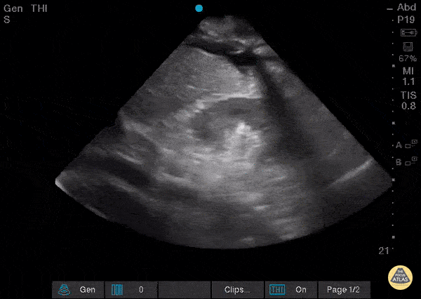 Diaphragmatic Contraction