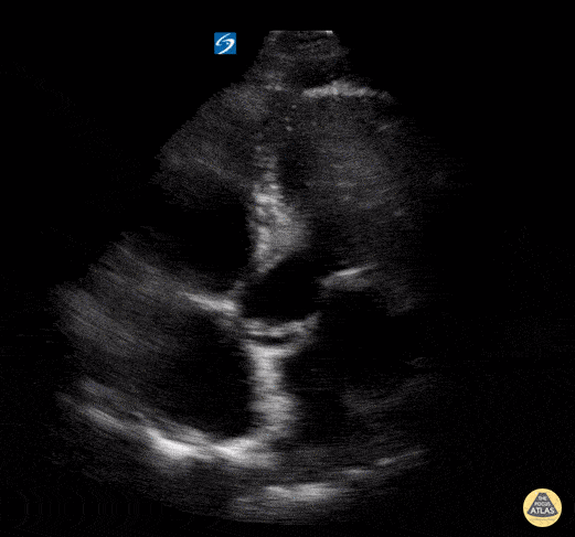 Apical 5 Chamber - Normal
