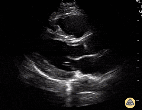 Parasternal Long Axis - Normal