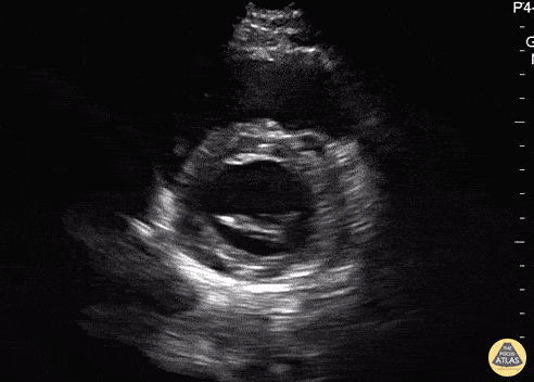 Parasternal Short Axis (Mitral Valve) - Normal