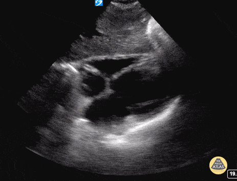 Subxiphoid / Subcostal - Normal
