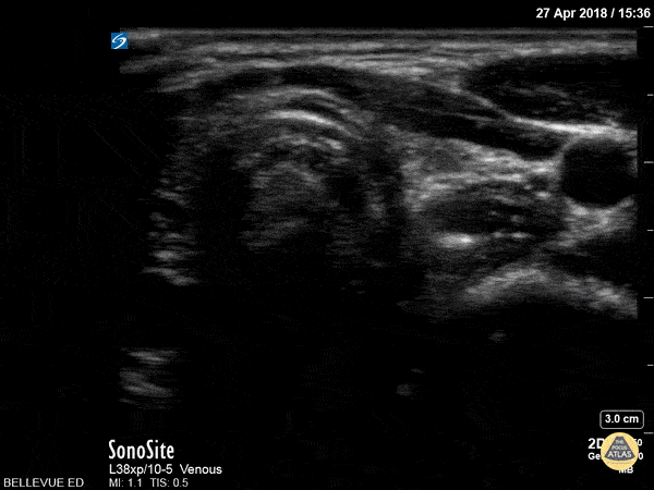 Thyroid Left Lobe