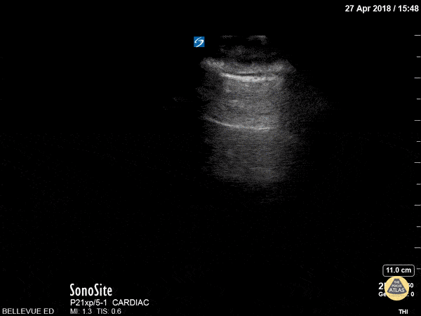 Lung Sliding and A-lines