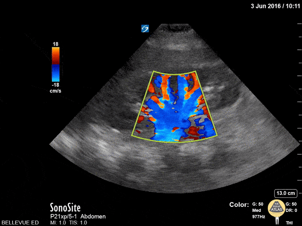 Kidney Doppler
