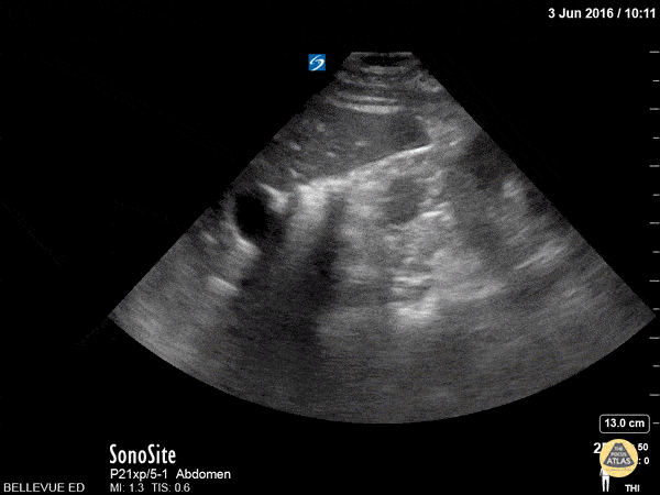 Kidney Transverse