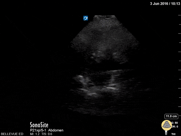 LUQ Kidney Long Axis