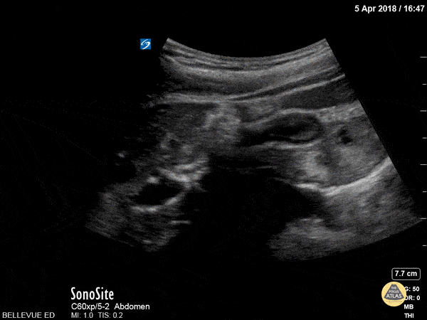 Contracted Gallbladder