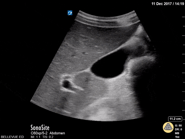 Gallbladder and Right Hepatic Artery