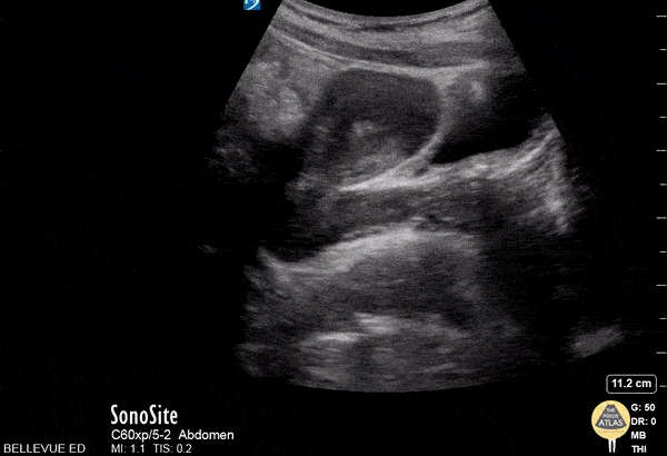 Transabdominal Uterus Long Axis