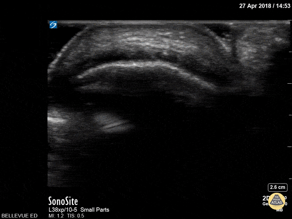 Achilles Tendon Short Axis