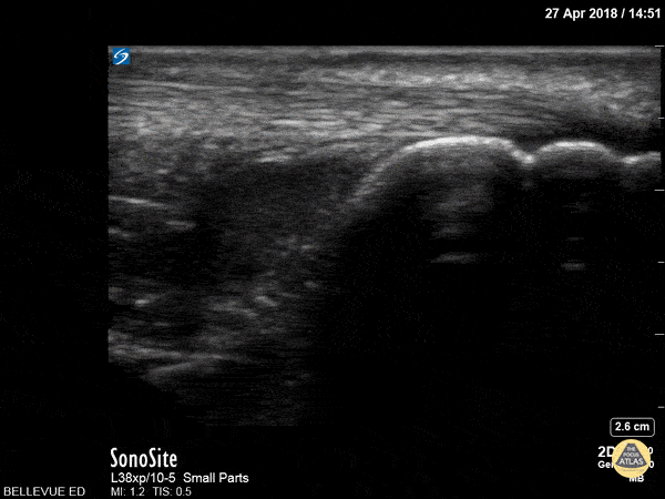 Achilles Tendon