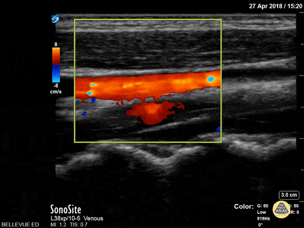 Carotid vs IJ - Doppler