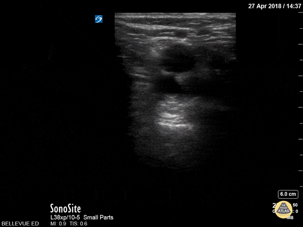 Popliteal Compression Test