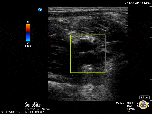 Popliteal Vasculature - Doppler