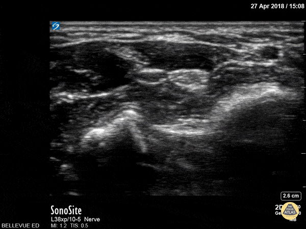 Median Nerve
