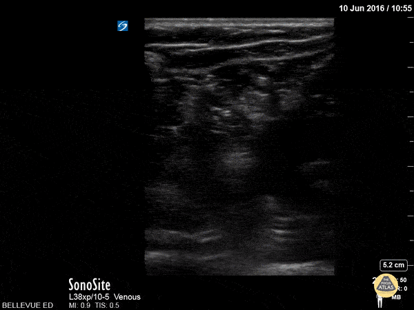 Sciatic Nerve