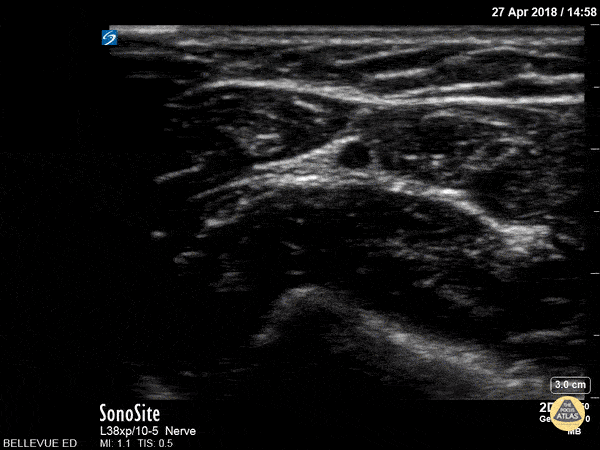Ulnar Nerve