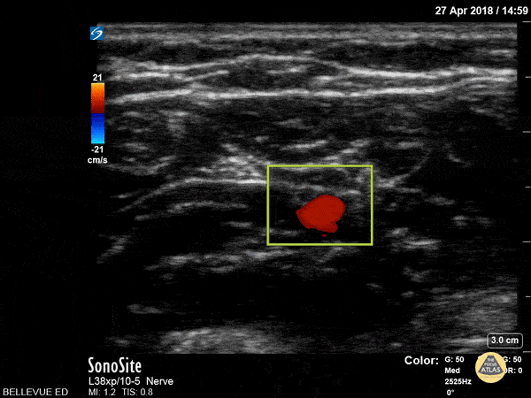 Ulnar Nerve and Artery