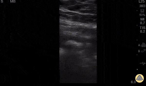 Appendicitis Longitudinal