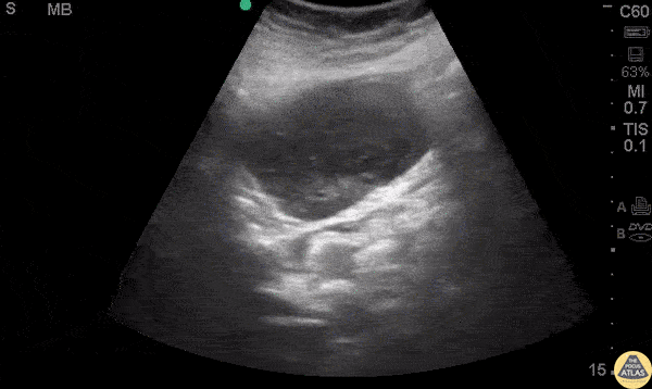 GI Tumor - GIST