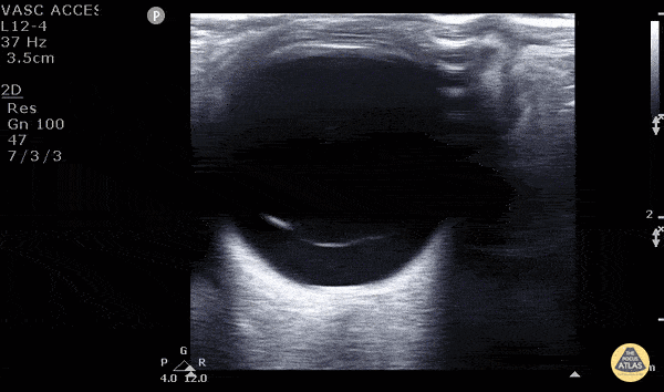 Vitreous Detachment