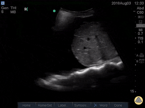 Spine Sign