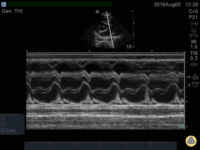 Cardiac Tamponade RV Diastolic Collapse M-mode