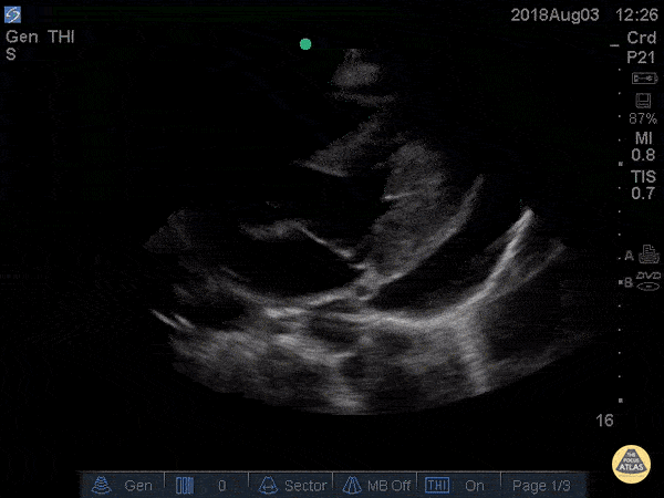Cardiac Tamponade Parasternal Long