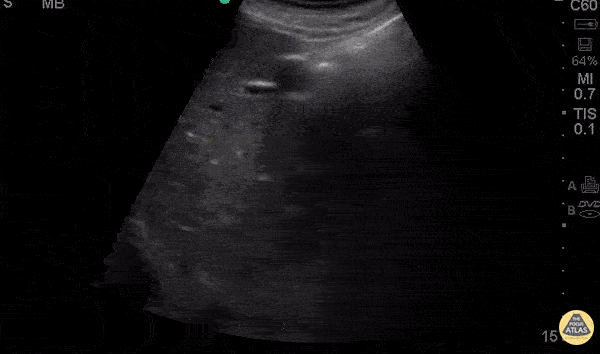 Splenic Sequestration