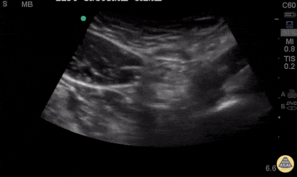 Inguinal Hernia With Peristalsis