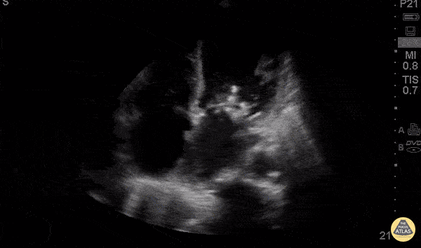 Mitral Vegetations