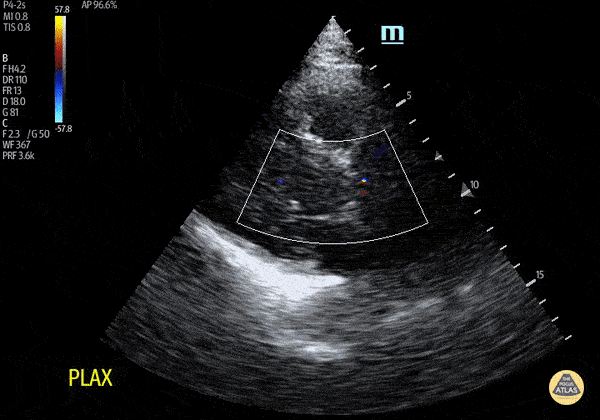Aortic Root Dilation with Aortic Regurgitation