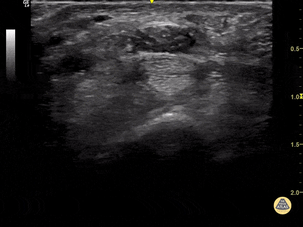 Median Nerve Injection