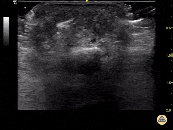 Foreign Body Flexor Tendon Sheath