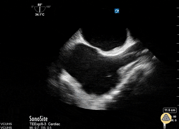 TEE - ECMO Placement Confirmation