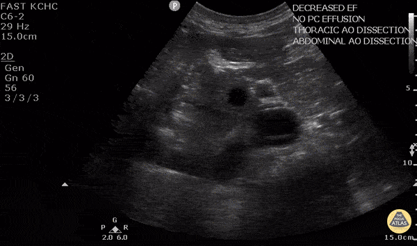Aortic Dissection