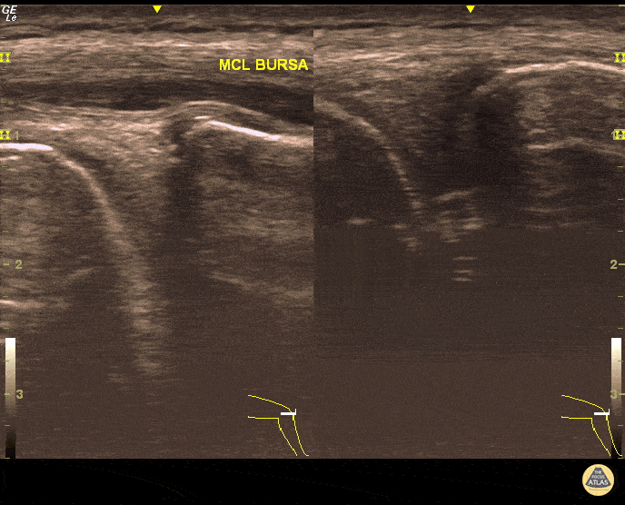 MCL Bursitis