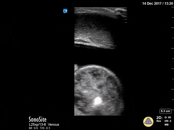 Strangulated Inguinal Hernia