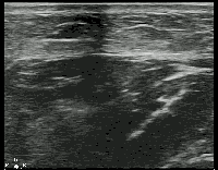 Compression for Abscess Identification