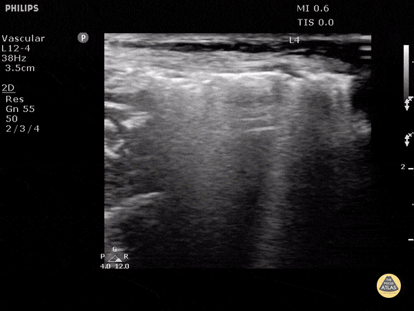 Subcutaneous Emphysema