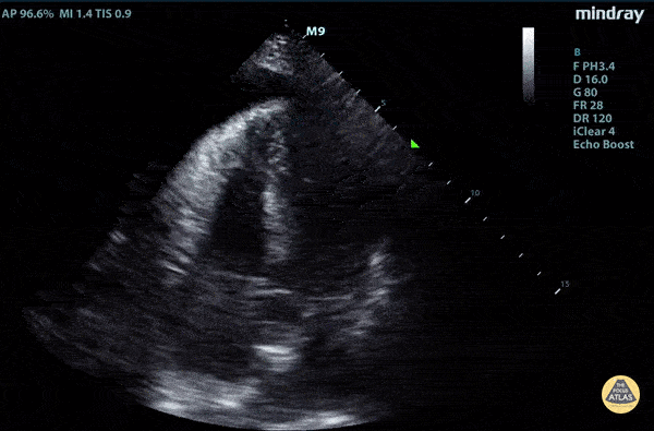 Aortic Dissection with Tamponade