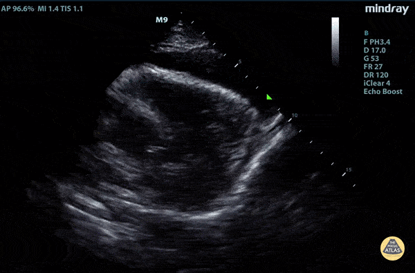 Parasternal Long Type A Aortic Dissection with Tamponade