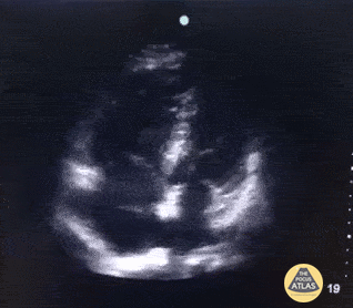 Right Atrial Thrombus