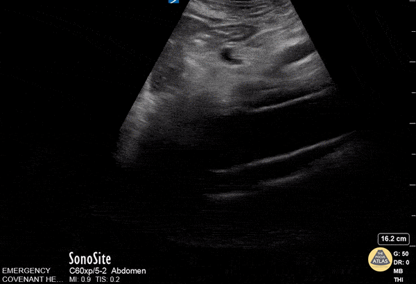 Thoracic Aortic Dissection