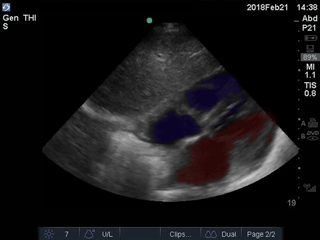 Subxiphoid - Colorized