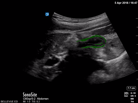 Contracted Gallbladder - Colorized