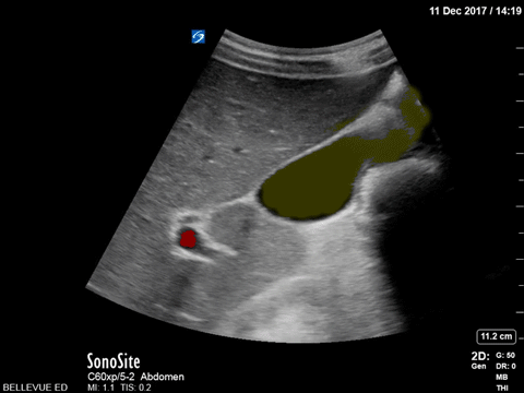 Normal Gallbladder - Colorized