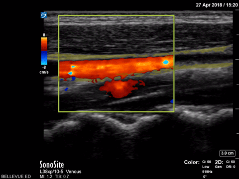 Internal Jugular and Common Carotid Doppler (long axis) - Colorized
